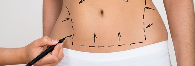 Abdominoplastia